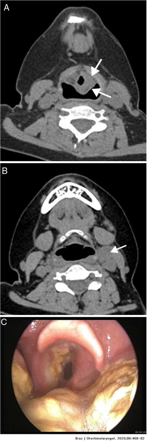 Non Squamous Cell Carcinoma Diseases Of The Larynx Clinical And