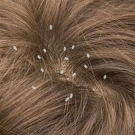 Lice In Hair Home Remedy In Urdu Caraway Seeds Health Benefits