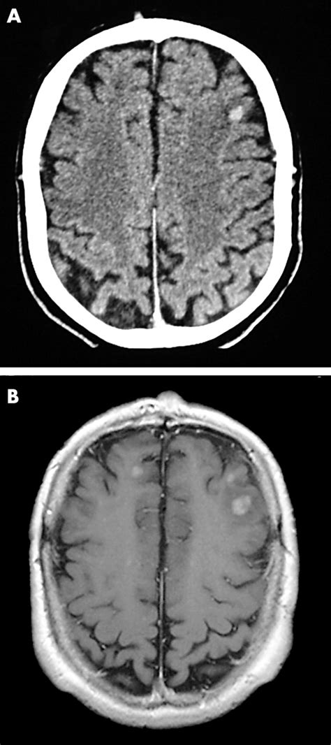 Maybe you would like to learn more about one of these? Overview of the diagnosis and management of brain, spine ...