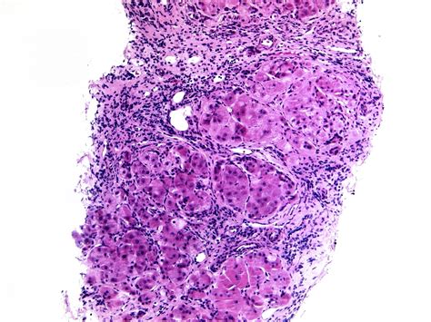 Alcoholic Liver Cirrhosis Histology