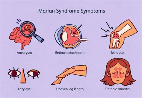 These Are The Symptoms Of Marfan Syndrome Medizzy