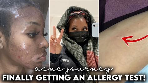 Vlog Acne Journey Getting My First Allergy Test Kensthetic Youtube