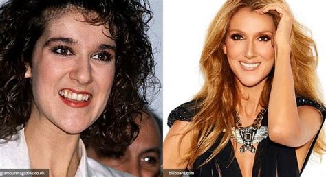 What Did Celine Dion Have Done To Her Teeth