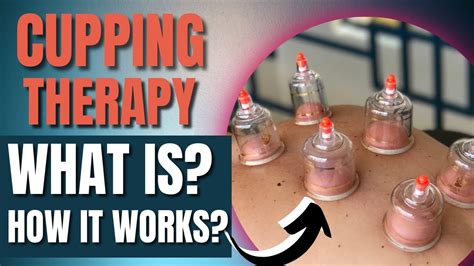 What Is Cupping Therapy How Does It Works Understanding Everything About Cupping Therapy Youtube