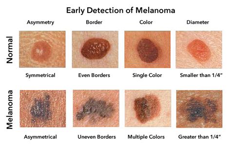 Melanoma Skin Cancer Types Stages Signs Symptoms Treatment