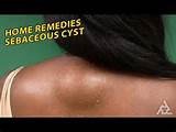 Images of Home Remedies Sebaceous Cyst