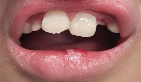 Bumps Inside Lips Causes Small Clear White Or Red Bumps Treatments