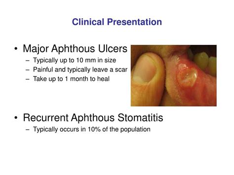 Ppt Oral Medicine Block Presentation Aphthous Ulcers Powerpoint