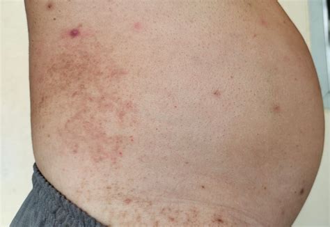 Mens Belly Rash Hives Itchy On The Body The Waistline Of The Fat People