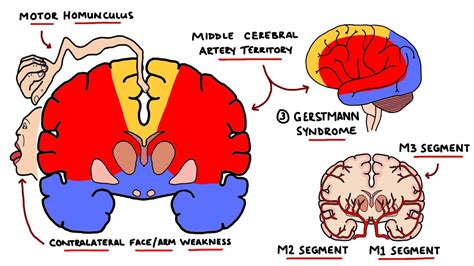 Middle Cerebral Artery Stroke Syndromes MCA Stroke Syndromes With Gerstmann Syndrome