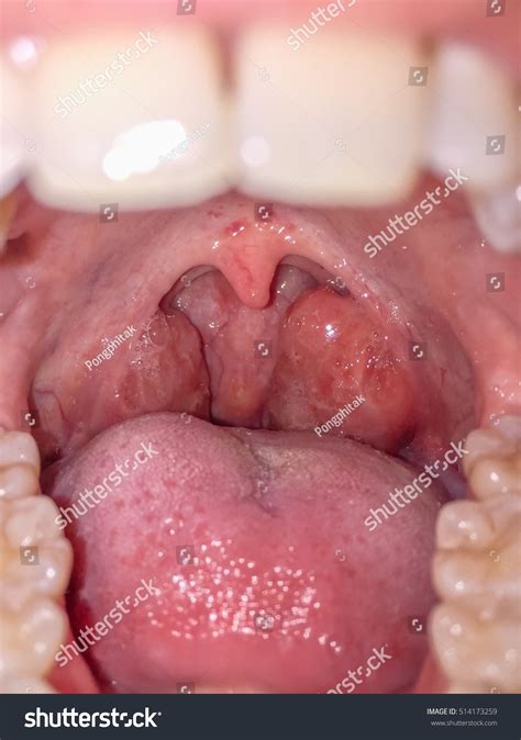 Стоковая фотография 514173259 Tonsils Swollen Due Inflammation Patient