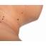 Skin Tag Removal Surgery Singapore  APAX Medical & Aesthetics Clinic