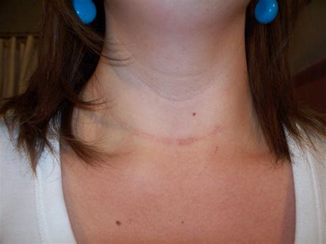 Scar Year Later After Thyroid Cancer Surgery Flickr Photo Sharing