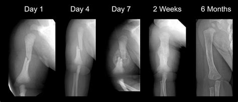 Hanging Arm Cast For Humerus Fracture