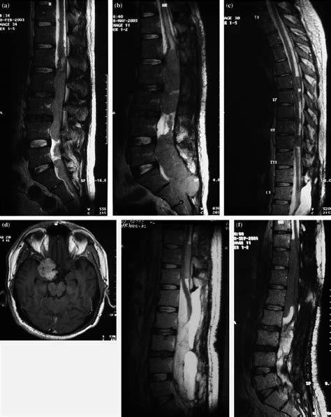 A Sagittal T2 Weighted Mr Scan Of The Lumbar Spine On Admission A