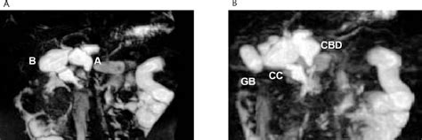 Figure 1 From Another Type Of Choledochal Cyst Beyond The Todani