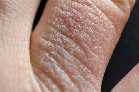 Hand Dermatitis Finger Eczema Stock Photo Download Image Now Istock