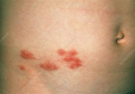 Pictures Of Herpes Zoster Shingles