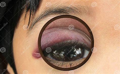 Magnifying A Black Eye Stock Photo Image Of Injury Swelling 93770876