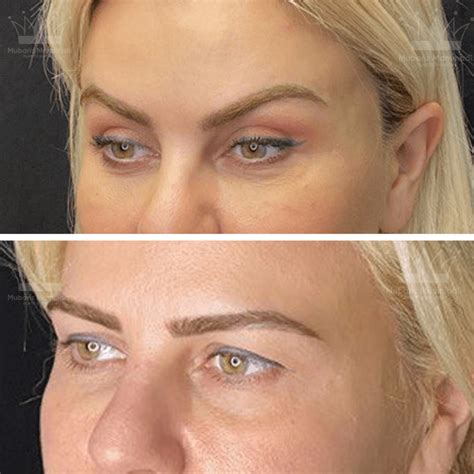 Endoscopic Brow Lift And Forehead Lift Surgery
