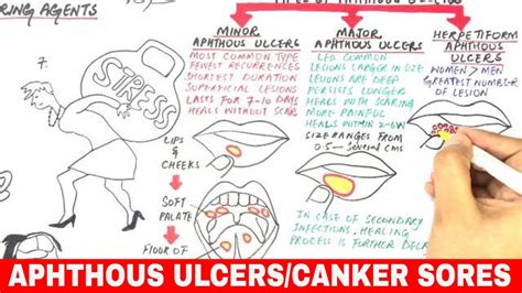 Aphthous Ulcers Canker Sores Pathophysiology Triggers Types