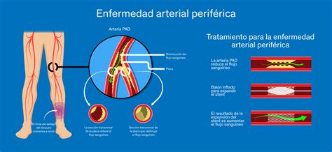 Peripheral Arterial Disease Abc Medical Center