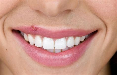 What Are Cold Sores Cold Sore Facts Symptoms And Causes