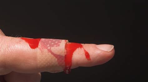 Even minor injuries can lead to bleeding, which lasts for days or weeks and can be fatal. Genius Community | Congenital Diseases