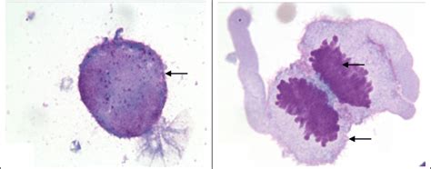 Csf Cytology Wright’s Staining × 400 Showing Malignant Cells 2 1 Download Scientific