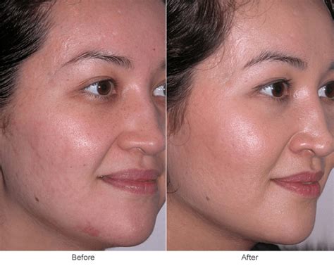 Treatment For Adult Acne In Women How Do You Get Clear Skin What Is Treatment For Acne Scars