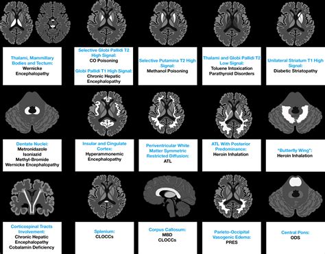 Imaging Patterns Of Toxic And Metabolic Brain Disorders Thalami