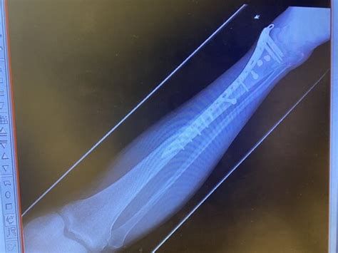 Distal Tibia Fracture Health And Fitness Thumpertalk
