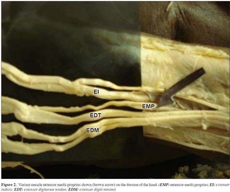 Variant extensor muscles on the dorsum of the hand