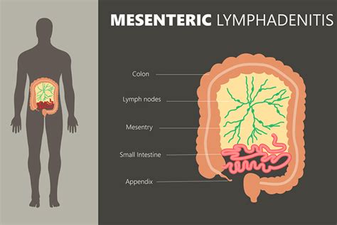 Mesenteric Lymphadenitis In Children Causes And Treatment