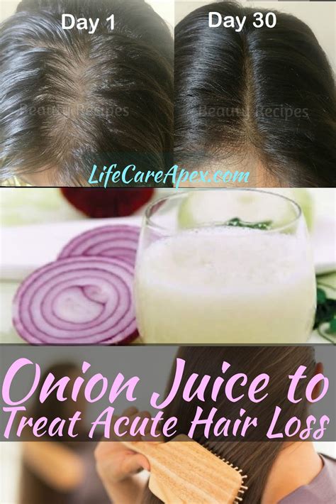 Intralesional triamcinolone acetonide injected intradermally. Onion Juice to Treat Acute Hair Loss - | Hair loss remedies