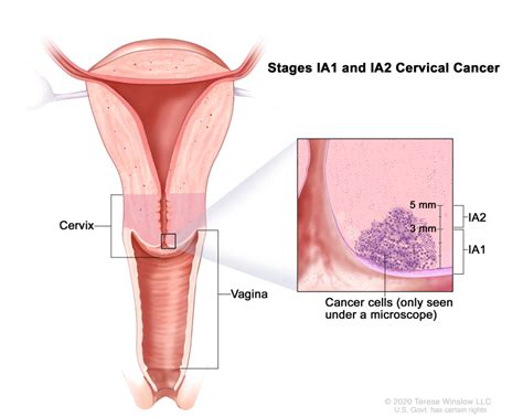 Cervical Cancer Treatment Pdq Cancer Information Summaries Ncbi