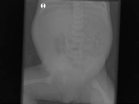 Figure 1 From Neonatal Gastric Perforation With Tension Pneumo Peritoneum Semantic Scholar
