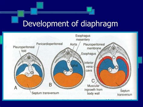Ppt Congenital Diaphragmatic Hernia And Eventration Of Diaphragm