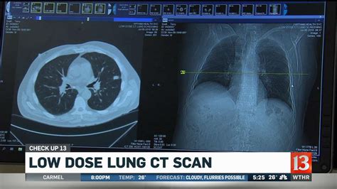 Check Up 13 Low Dose Lung CT Scan Wthr Com