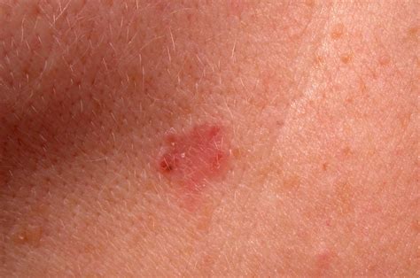 Sublinhado Surpreendase Conselho Symptoms Of Skin Cancer On Face Excitação Comum História