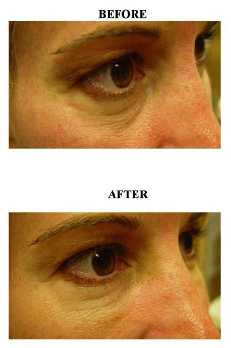 Before And After Fillers Tear Troughs Patient 02 The Medical Spa