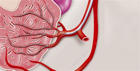 Prostatic Artery Embolization Pae Pae Treatment In Jaipur