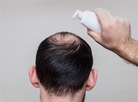 Top 72 Ketoconazole Shampoo Hair Loss Latest Ineteachers