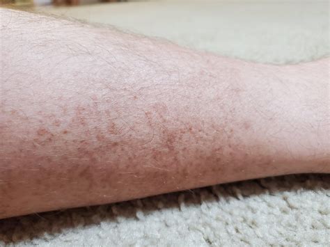 Brown Spots On Both Legs Medical