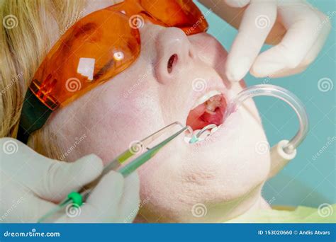 Dentist Inserting High Volume Evacuator Suction While Saliva Ejector Is In Mouth Stock Photo