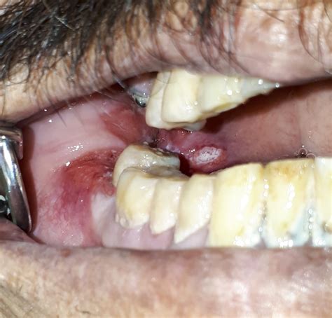 Cáncer De La Cavidad Oral Dental Para Cual