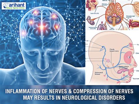 Inflammation Of Nerves And Compression Of Nerves May Results In