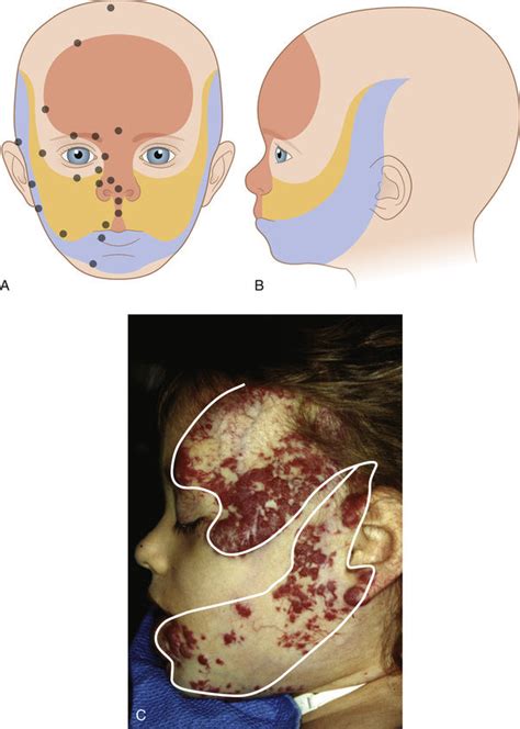 Infantile Hemangiomas And Other Vascular Neoplasms Ento Key
