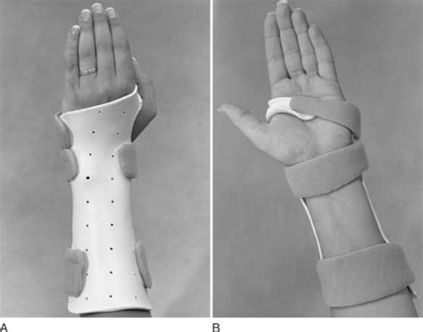 Splints Acting On The Wrist Musculoskeletal Key