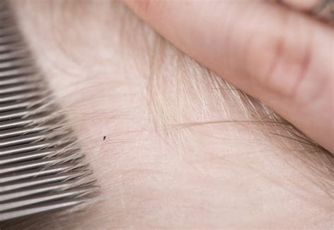 Super Lice Found In 25 States Resistant To Typical Treatments